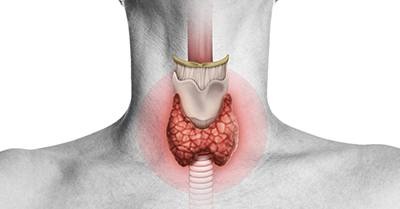 Hypothyroidism 
